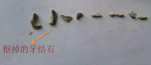 部分網友扣掉的牙結石