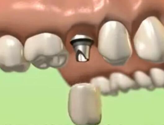 矯正完成後做種植牙