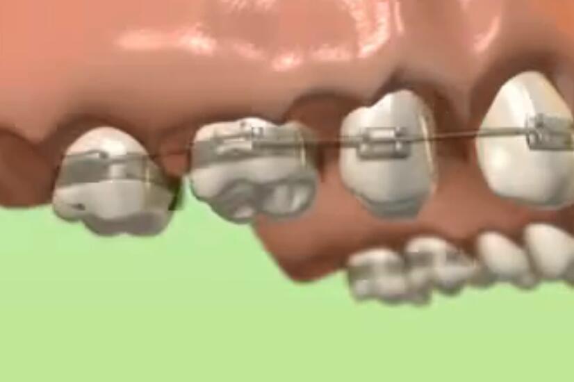 缺牙做牙齒矯正後種牙