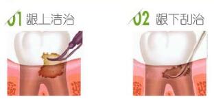 齦上潔治和齦下刮治