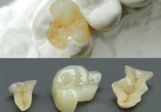 瓷嵌體(ti) 補牙