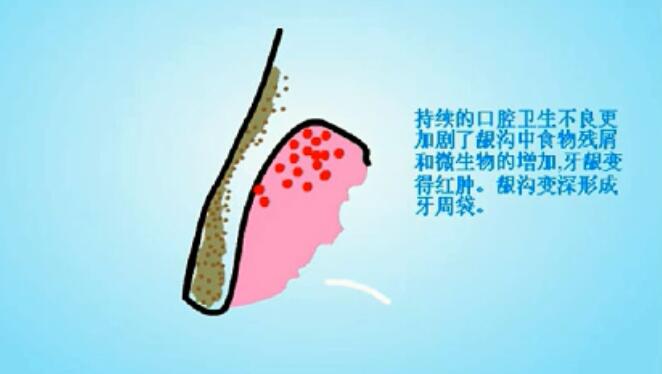 牙周袋的形成