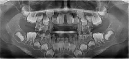 替牙期乳牙嚴(yan) 重齲壞牙片