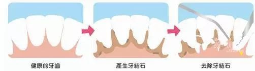 健康的牙齒到產(chan) 生牙結石