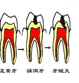 牙髓炎示意圖