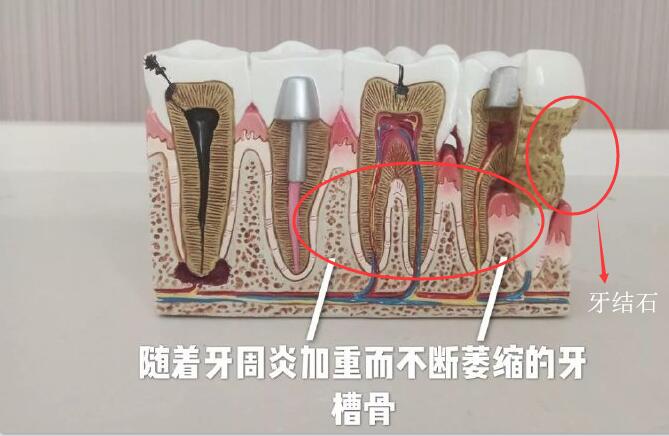 牙結石長期刺激造成牙齦萎縮