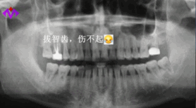 拔智齒價(jia) 格與(yu) 智齒位置示意圖
