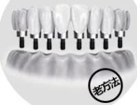 傳(chuan) 統種植牙