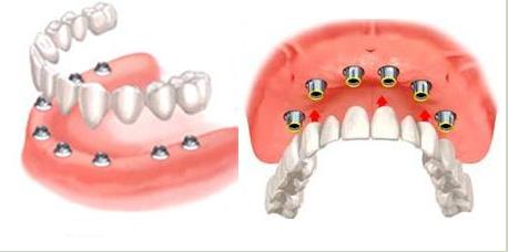 常見半口種植牙