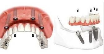 4顆種植體(ti) 修複半口種植牙