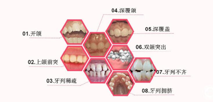常見的咬合不齊
