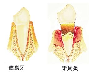 牙周炎和健康的牙齒