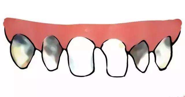 奶瓶齲嚴(yan) 重