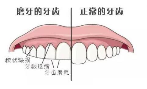 磨牙造成楔形缺損