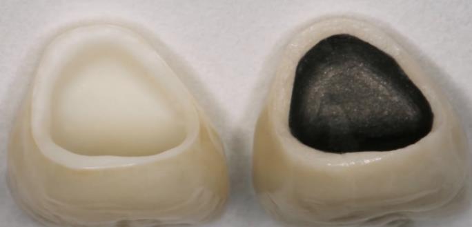 全瓷牙和烤瓷牙裏側(ce) 材料**