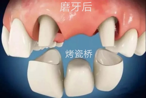 烤瓷冠