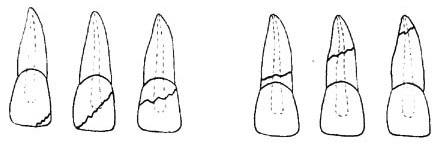 牙齒折裂不同程度
