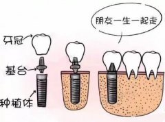 上麵四顆門牙意外磕掉了，一般要種植幾顆牙