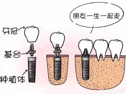 種植牙結構