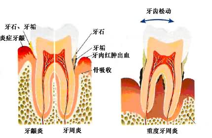 正常牙齒與(yu) 牙齦炎、牙周炎的區別