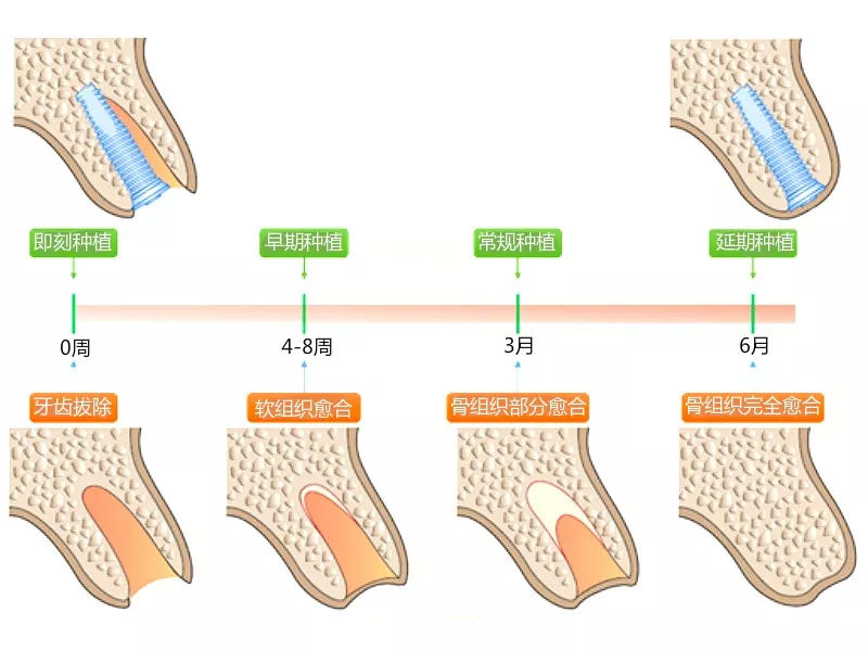 拔牙後種植牙