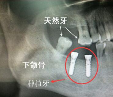 種植牙與(yu) 真牙