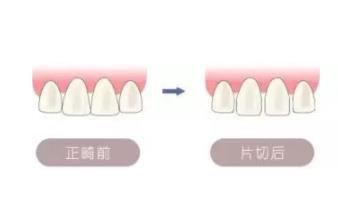 牙齒片切**
