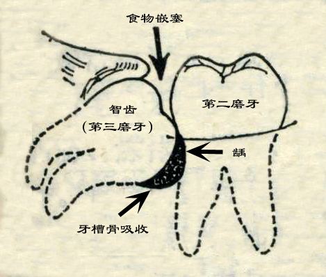 阻生智齒該拔不拔的危害