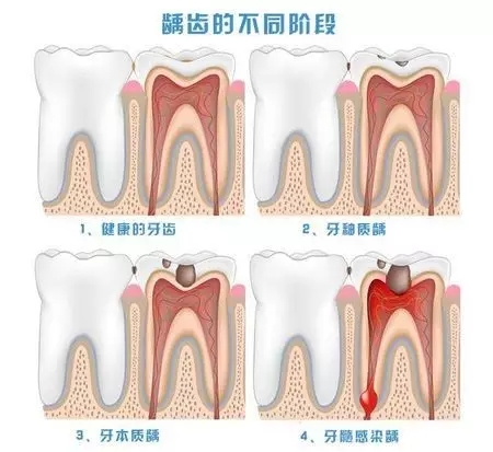 健康的牙齒到齲齒