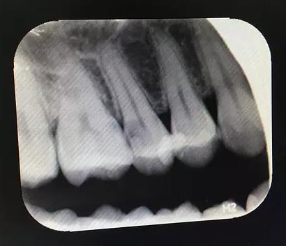 保髓還是根管治療