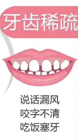 牙齒稀疏