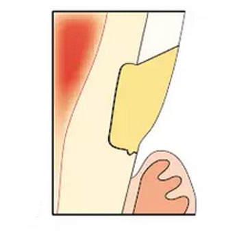 楔狀缺損補牙