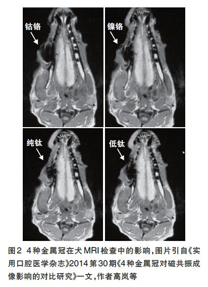 金屬對核磁共振的影響