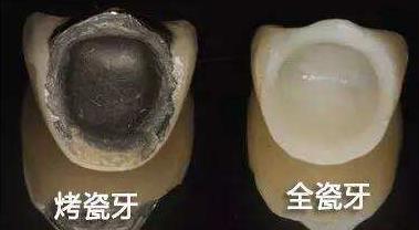 金屬烤瓷牙和全瓷牙