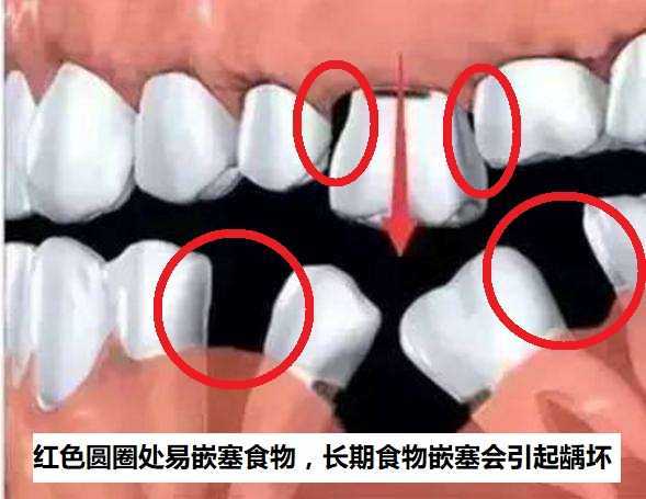 缺牙對鄰牙的危害