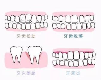 牙齒鬆動脫落