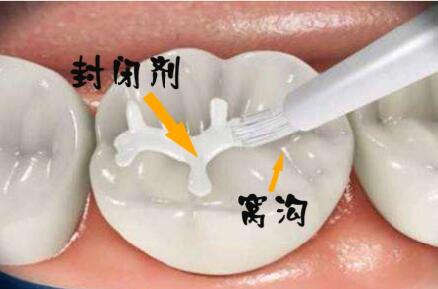 窩溝封閉