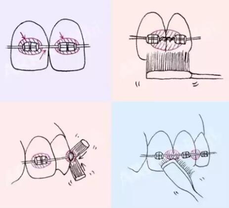 戴上托槽後怎麽(me) 刷牙
