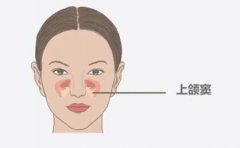 種植牙做上頜竇提升手術是什麽意思?