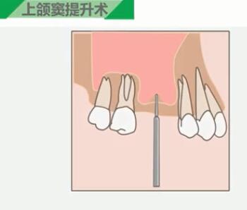 上頜竇提升