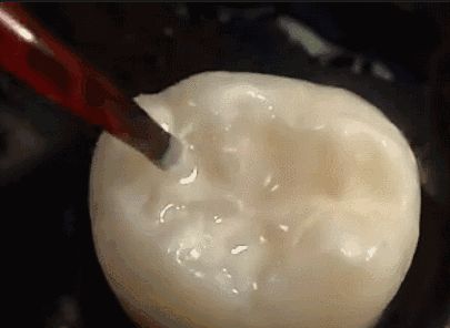 窩溝封閉實際操作