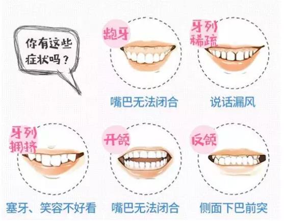 牙齒畸形示意圖