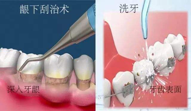 洗牙和齦下刮治