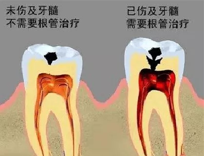 傷(shang) 及牙髓和未傷(shang) 及牙髓的示意圖