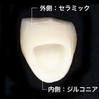 二氧化鋯全瓷牙
