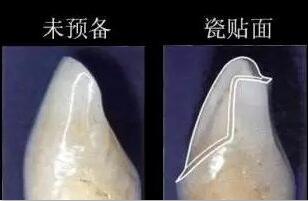 瓷貼麵磨牙