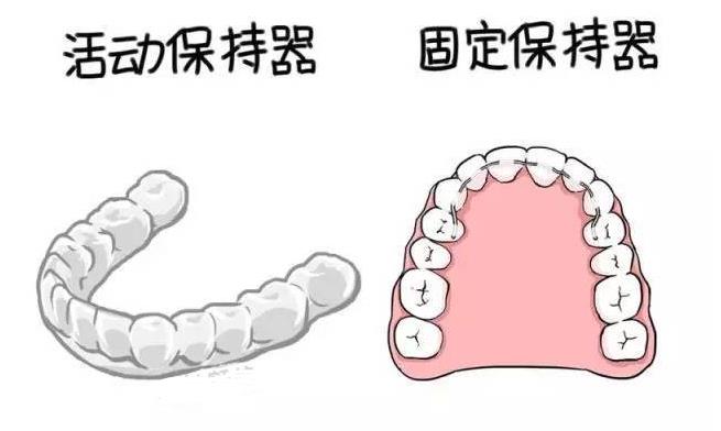 壓膜透明保持器和舌側(ce) 絲(si) 保持器