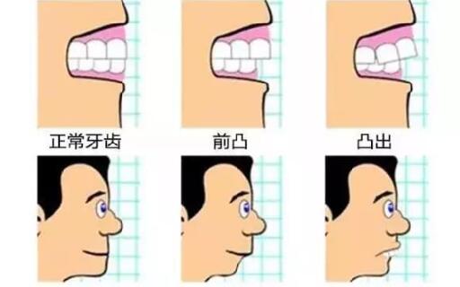 正常牙齒和牙齒前凸