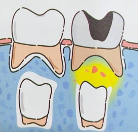 乳牙和恒牙的關(guan) 係