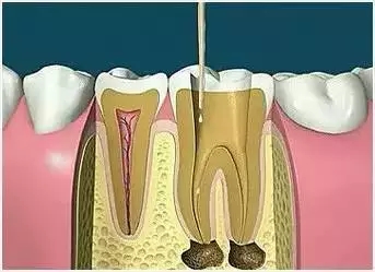 根管消毒